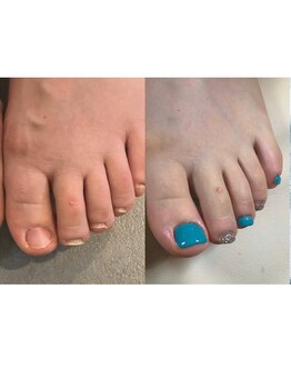 ティアラネイル 宇都宮/深爪矯正