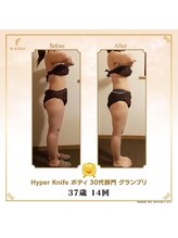 リンカ(Rinka.)/☆帯広初!!ハイパーナイフ導入☆