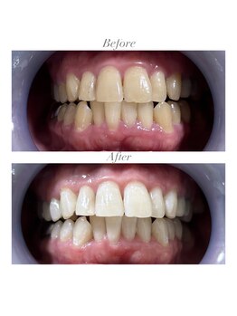ホワイトニングショップ 静岡店/ホワイトニングBefore→After