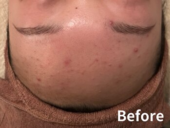 ダイヤモンド リーエンダ(Diamond leende)/クレイハーブピーリング