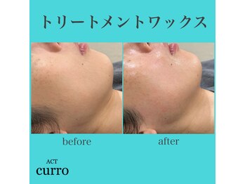 アクト クロ(ACT curro)/【フェイシャル】施術例