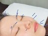 【美容鍼コース】フェイスケア　リフトアップなどでお悩みの方におすすめ♪