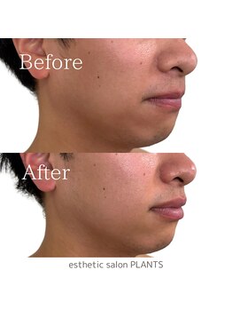 プランツ(PLANTS)/30代／１回／むくみ首凝り