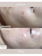 シミケア専門サロン Lotus. 千早香椎店【シミ/シワ/毛穴/小顔】/シミケア12回
