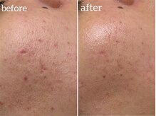 サロンリー(Salon Riee)の雰囲気（ニキビのあとの肌の凹凸にも効果的。肌質改善もお任せください。）