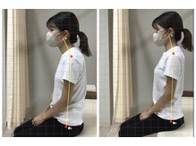 都筑たかやま整骨院/猫背矯正のビフォーアフター