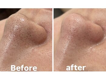 毛穴洗浄・肌質改善専門店 -SODATSU- skin salon【6/1 NEW OPEN】の写真/《黒ずみ・角栓ごっそり！》浮き出る毛穴洗浄で驚きの毛穴レス体験♪ハイドロフェイシャルで透明感溢れる肌