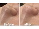 毛穴洗浄・肌質改善専門店 -SODATSU- skin salon【6/1 NEW OPEN】の写真/《黒ずみ・角栓ごっそり！》浮き出る毛穴洗浄で驚きの毛穴レス体験♪ハイドロフェイシャルで透明感溢れる肌