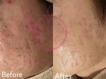 サロンヴェアリー 広尾(salon vary)/テクスパ2回でこの結果！#敏感肌