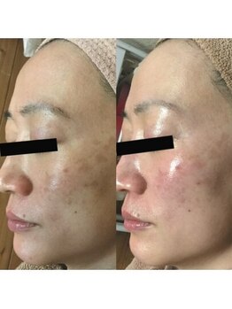 ホワイトアクア 姫路店(WHITE AQUA)/ハーブピーリング/姫路/美肌