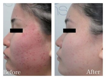 イヨヨ(iyoyo)/BeforeAfter