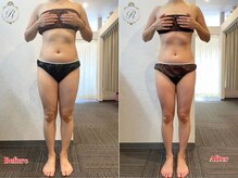 ルフレ(REFLET)/【事例12】Before/After痩身