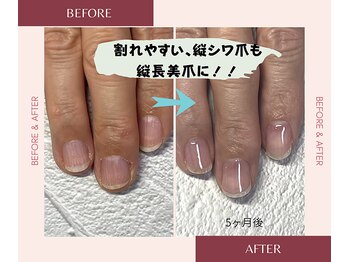 割れやすい!縦シワ爪も大変身