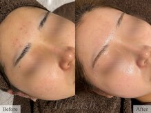 ティアラッシュ(TiaLash)/REVI陶肌トリートメント