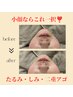 《新規限定》　たるみ・二重あごが気になる方 | 小顔リフト¥6,600