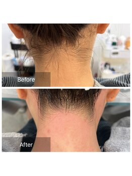 アート 熊本並木坂店(ART)/うなじ脱毛/フラッシュワックス