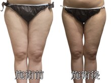 エリクシア 松戸/30代太もも痩身１２回目