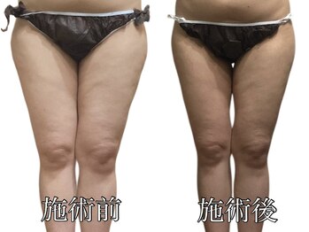 エリクシア 松戸/30代太もも痩身１２回目