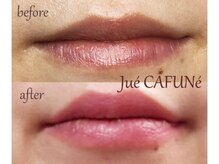 ジュエカフネ 広尾(JueCAFUNe)/《ルメラ》 唇メラニンケア症例