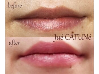 ジュエカフネ 広尾(JueCAFUNe)/《ルメラ》 唇メラニンケア症例