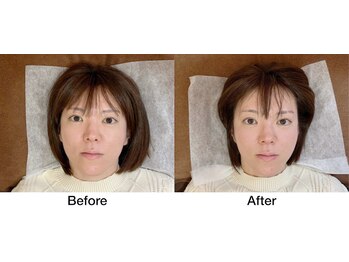 こじま 富雄団地接骨院/フェイスライン・むくみ