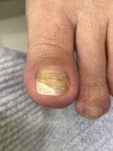 フットメンテ 巻き爪矯正センター 南浦和/肥厚爪