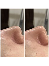 アイリーン(IRENE)/毛穴洗浄の効果実感♪