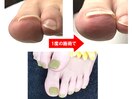 巻き爪だけどフットジェルしたい