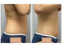 FJ/脂肪撃退コース◆痩身