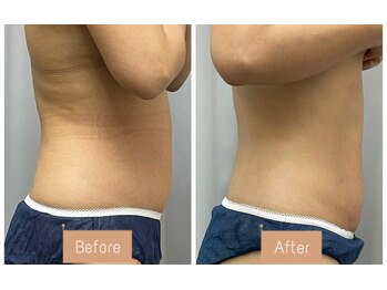 FJ/脂肪撃退コース◆痩身