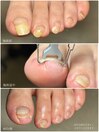 巻き爪改善ケア