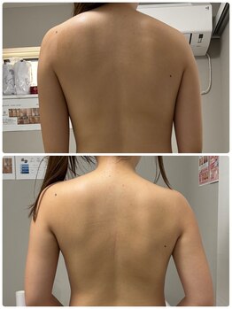 リクラ 北千住(Reclat)/背中1回のビフォーアフター