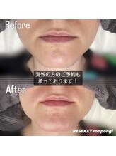 リゼクシー INTERNATIONAL麻布十番 六本木(RESEXXY)/海外の方も/髭脱毛