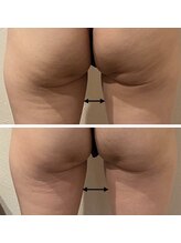 パウザ(PAUSA)/脂肪冷却ダイエット