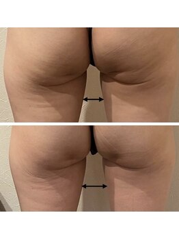 パウザ(PAUSA)/脂肪冷却ダイエット