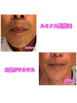 ヘルシースリム 東浦和/ヒゲ脱毛って絶対お得♪