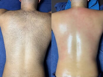 クラウン ジュエルズ(CROWN JEWELS)/背中 Wax脱毛