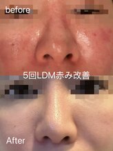 ユミ 町田鶴川店/LDM赤ら顔/肌荒れ改善