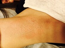 ルルゴ(LULUGO)/両脇ワックス脱毛