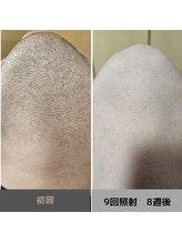 キムラケ 和光別邸(木村家 KIMURAKE)/メンズ脱毛ヒゲビフォーアフター