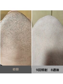 キムラケ 和光別邸(木村家 KIMURAKE)/メンズ脱毛ヒゲビフォーアフター