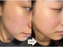 アイル 江坂店(iru)/ハーブピーリング1回目