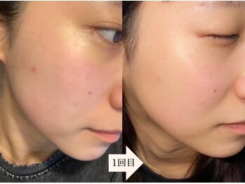 アイル 江坂店(iru)/ハーブピーリング1回目