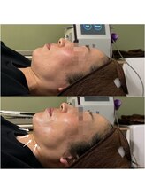 ミヨン(Miyong)/LDM＆ロングパルスリフティング