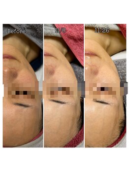 オルオル 天神大名店(Olu-.olu.)/肌質改善「しみ」「改善」