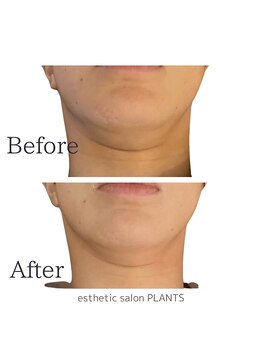 プランツ(PLANTS)/30代／１回／二重あご