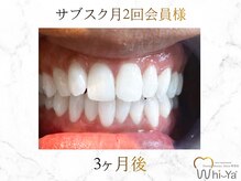 ホワイヤ セルフホワイトニング DBS神楽坂(Whi-Ya)/☆サブスク会員様☆納得の白さ☆