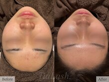 ティアラッシュ(TiaLash)/REVI陶肌トリートメント