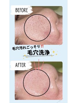 グラシア(gracia)の写真/スッピンでも自信の持てるツルスベ肌に！当店人気NO.1★【毛穴汚れ・黒ずみ撃退コース¥7,300→¥3,630】