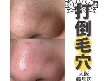 リッカロッカ(RIKKA&ROCCA)/打倒毛穴